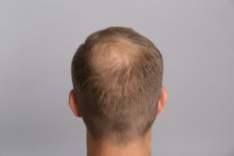 Crown Balding