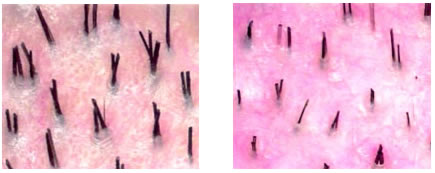 Normal scalp (left) and scalp with miniaturization (right)