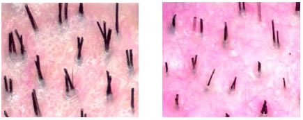 Guide to Hair Restoration - Alopecia Diagnosis