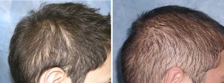 Densitometry and Video-Microscopy in the Hair Transplant Evaluation