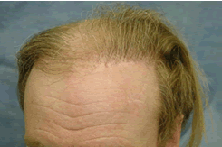 Pluggy, Scarred Hairline