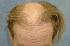 Donor Supply after Multiple Hair Transplants