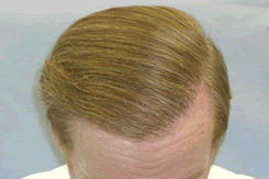 Coverage Transplanted to Top of Scalp