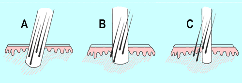 Guide to Hair Restoration - Punch size