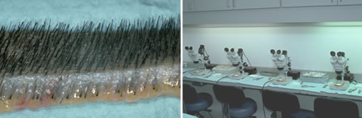 Donor strip and microscope use in hair transplant