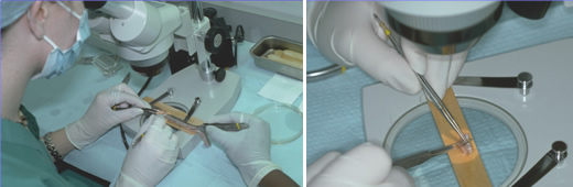 Hair transplant surgery - follicular unit dissection