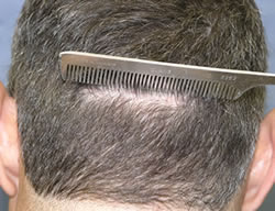 Appearance of typical stapled closure six weeks post-op