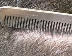 Note that there is little trace of donor area scar even with the hair cut relatively short