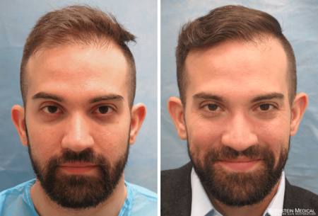 Before After - Patient CFQ