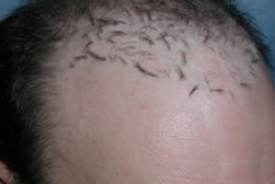 Hair Plug Removal | Graft Excision | Bernstein Medical