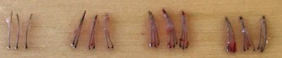FIGURE 6. 0.9mm needle: 1-, 2-, 3- , and 4-hair follicular unit grafts