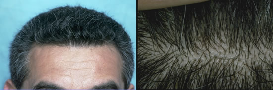 Follicular Units in FUT Hair Transplants | Bernstein Medical