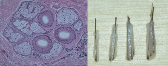 Hair follicles under the microscope and in follicular units