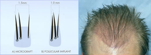 Growing from one multiple follicle hairs Can Multiple