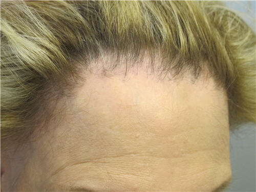 Frontal fibrosing alopecia is a scarring form of hair loss seen mostly in women