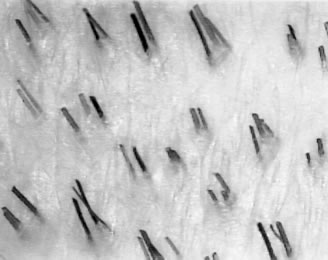 Follicular Transplantation - Natural Hair Groupings, High Density