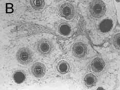 Follicular Unit Extraction - Cross-section views of follicular units - Subcutaneous fat layer