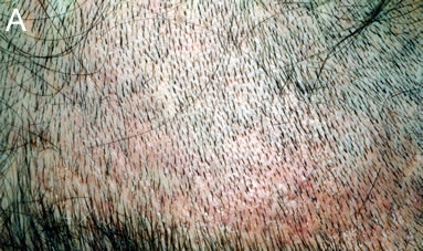 Follicular Unit Extraction - Donor area 3 weeks post-op showing mild residual erythema
