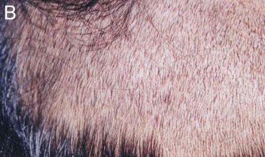 Follicular Unit Extraction - Donor area 3 months post op