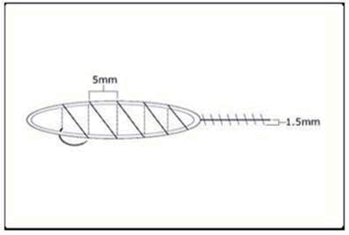 Follicular Unit Hair Transplantation - Schematic of the suturing technique recommended for sewing the donor scalp