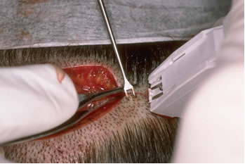 Follicular Unit Hair Transplantation - Stapling technique illustrating very controlled apposition of wound edges, using skin hooks for the lower edge and forceps to evert the upper