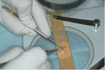 Follicular Unit Hair Transplantation - Generating individual follicular units