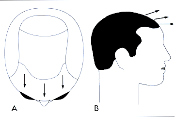 Follicular Unit Hair Transplantation - Normal hair direction