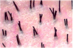 Follicular Unit Hair Transplantation - Natural hair groupings as seen through a densitometer (magnification x 30)