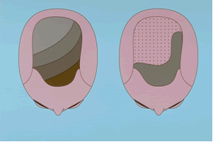 Follicular Unit Hair Transplantation - Schematic of 'side weighting'