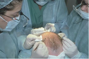Follicular Unit Hair Transplantation - Staff using loop magnification and curved jeweler's forceps to place follicular unit grafts into pre-made recipient sites