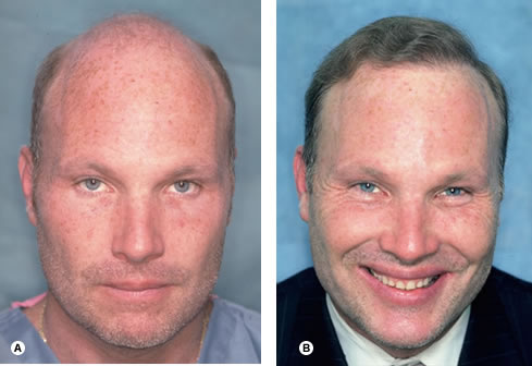 Follicular Unit Hair Transplantation - Recipient site influences on hair growth