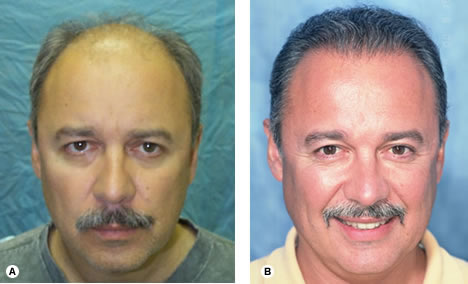 Follicular Unit Hair Transplantation - Recipient site influences on hair growth