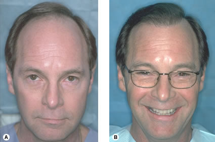 Follicular Unit Hair Transplantation - Recipient site influences on hair growth