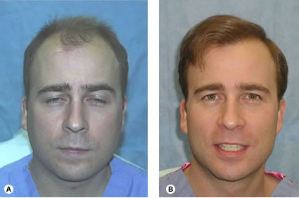 Follicular Unit Hair Transplantation - Recipient site influences on hair growth