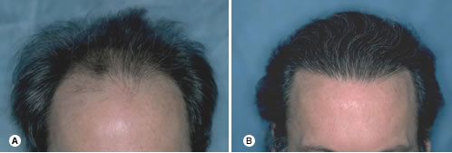 Follicular Unit Hair Transplantation - Recipient site influences on hair growth