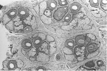 Follicular Unit Hair Transplantation - Histological view of follicular units corresponding to the natural hair groups observed on the scalp surface