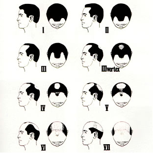 Follicular Unit Hair Transplantation - Norwood Classification