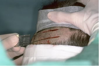 Follicular Unit Hair Transplantation - Donor-strip harvesting using two parallel blades on a Rassman handle pre-angled at 30º to allow both blades to lie flush against the scalp