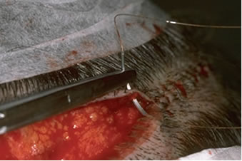 Follicular Unit Hair Transplantation - Suturing the donor area using absorbable sutures