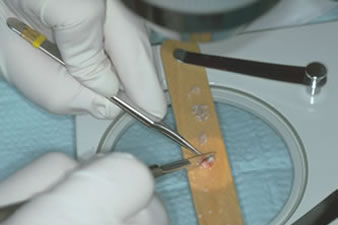 Follicular Unit Transplantation - Slivers are dissected into individual follicular units