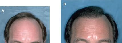 Follicular Unit Transplantation - Before and After Hair Transplant - High density was achieved in two hair restoration sessions by keeping the frontal area relatively narrow