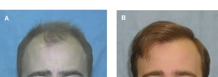 Follicular Unit Transplantation - Before and After Hair Transplant - High density was achieved in two sessions by taking advantage of side-to-side layering
