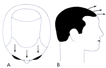 Follicular Unit Transplantation - Hair Direction