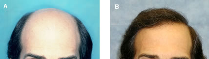 Follicular Unit Transplantation - Before and After Hair Transplant - Norwood Class 6/7 patient with straight, medium-fine, dark hair and light skin