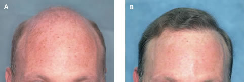 Follicular Unit Transplantation - Before and After Hair Transplant - Norwood Class 6/7 patient with slightly wavy fine, blond hair and light skin