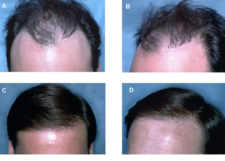 Follicular Unit Transplantation - Before and After Hair Transplant - Corrective Procedures
