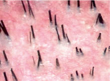 Follicular Unit Transplantation - Miniaturization: Thick terminal hair, fine vellus hair, and hair of intermediate diameter (miniaturized hair)