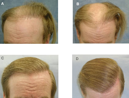 Follicular Unit Transplantation - Before and After Hair Transplant - Four corrective procedures were performed to remove the large grafts and redistribute them as individual follicular units in the front part of his scalp