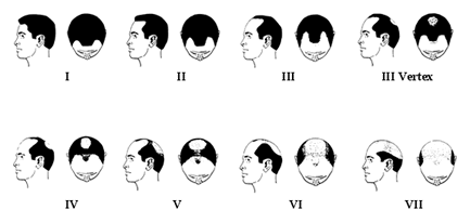 Follicular Unit Transplantation - Norwood Classification – Common Type