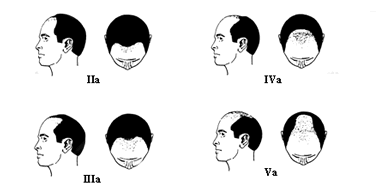 Follicular Unit Transplantation - Norwood Classification – Type A Variant